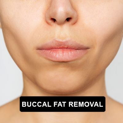 Buccal Fat Removal Surgery