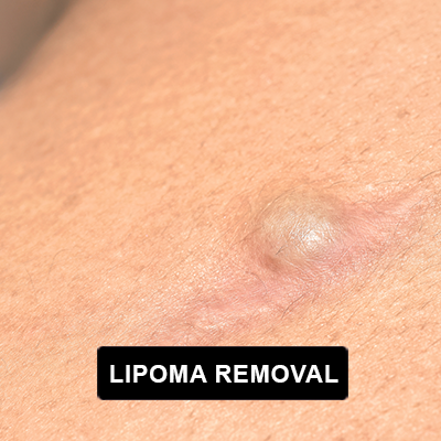 Lipoma Removal
