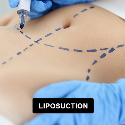 Liposuction Surgery