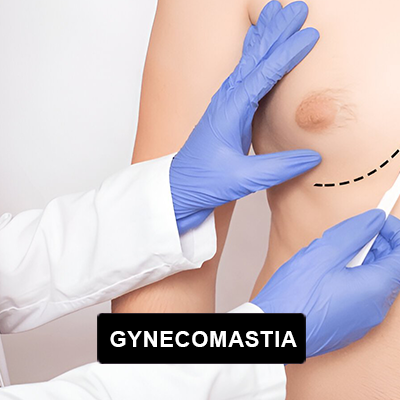 Gynecomastia Surgery